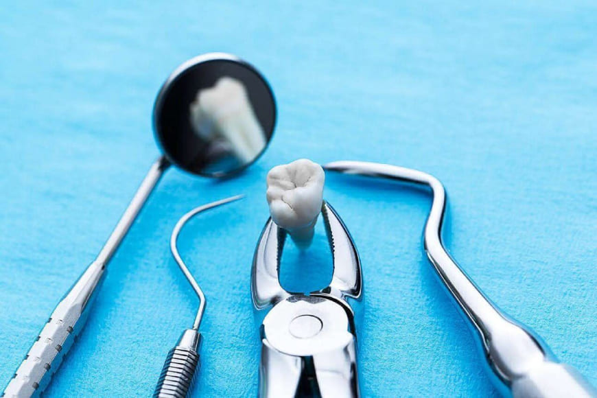 Резекція зуба – що це таке і коли проводиться?