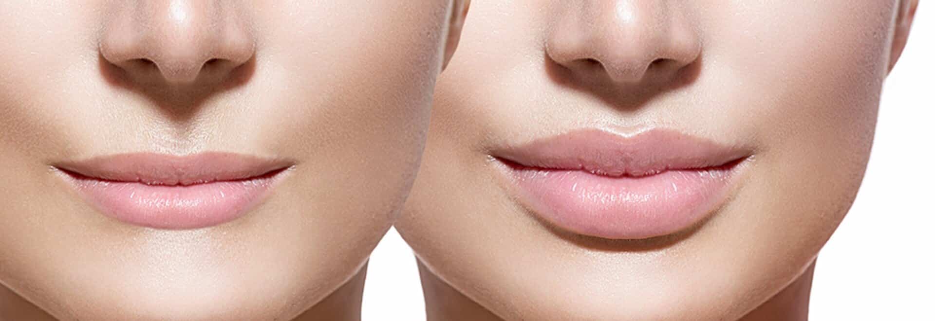 Масаж після збільшення губ - як правильно розминати губи